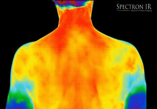 Medical Thermography Image 